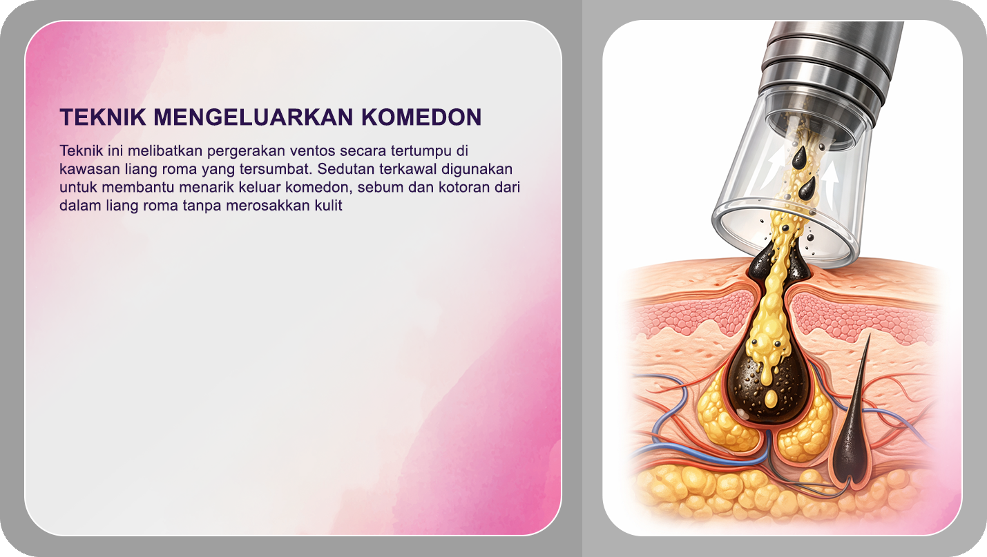 Teknik Mengeluarkan Komedon